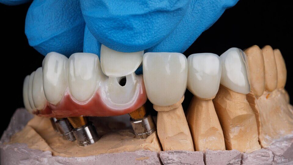 Preventative Dentistry